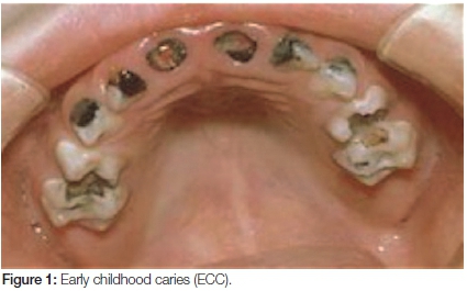 Carie della prima infanzia (Early Childhood Caries, ECC)